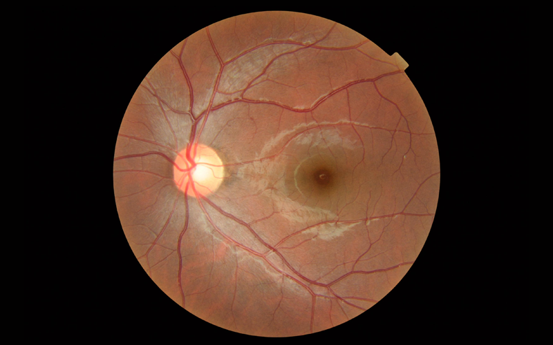 G-Retina,-Macular-and-Vitreous