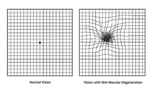 Amsler Grid - Dr. Sharang Wartikar